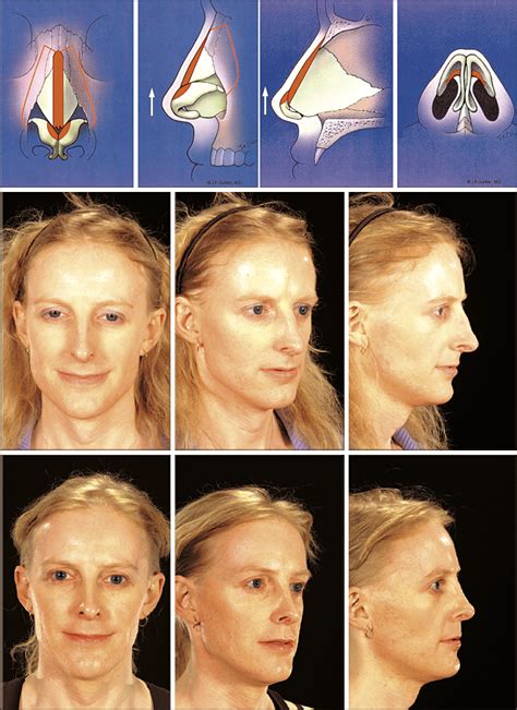 The Role Of Nasal Feminization Rhinoplasty In Male To Female Gender Reassignment Jama Facial
