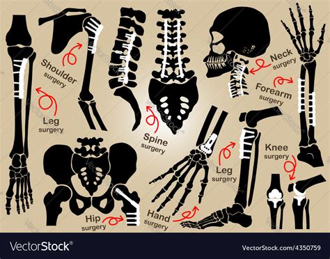 collection orthopedic surgery royalty free vector image