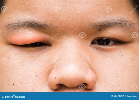 Swollen Red Upper Eye Lid With Onset Of Stye Infection Stock Photo