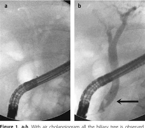 Figure 1 From Air Cholangiogram Is Not Sufficent To Detect Common Bile