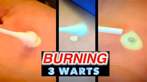 burning off 3 big warts with liquid nitrogen dr paul youtube