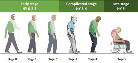 The Hoehn And Yahr Scale Classifying Different Stages Of Parkinsons