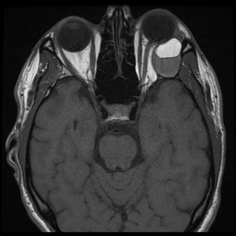 Orbital Dermoid Cyst Radiology Reference Article