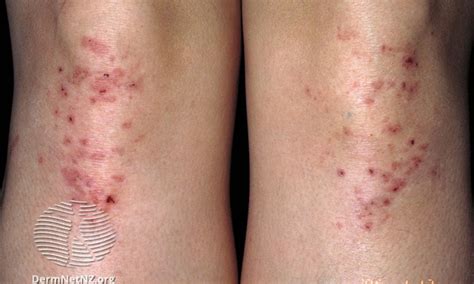 Dermatitis Herpetiformis Nhs Inform