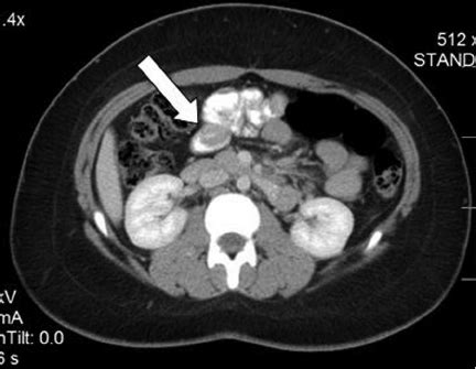 CT Abdomen Pelvis Without Contrast Note The Intussusception In The
