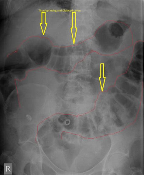 Ischemic Colitis Abdominal X Ray Wikidoc