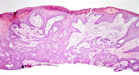 Porocarcinoma Arising In A Precursor Poroma Dermatopathology