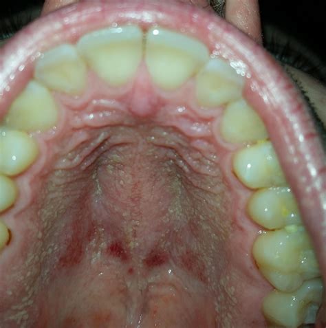 Rash On Roof Of Mouth Any Advice Appreciated Dentistry