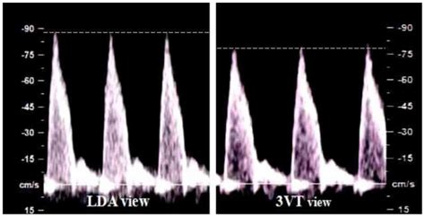 Ductus Arteriosus Ultrasound