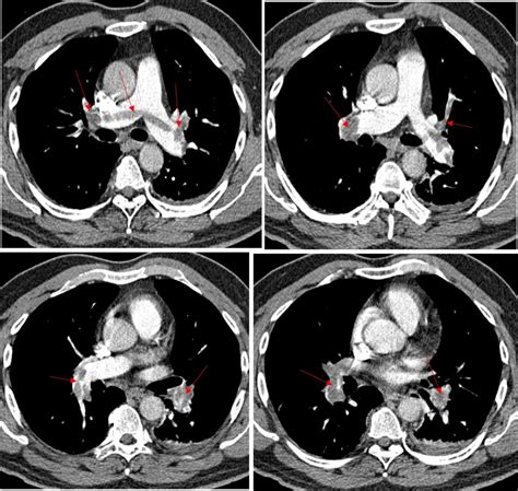 Saddle Pulmonary Embolism Radiology Cases