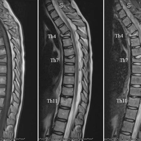 Thoracic Mri At First Visit Shows Compression Fractures Of T4 T7 And