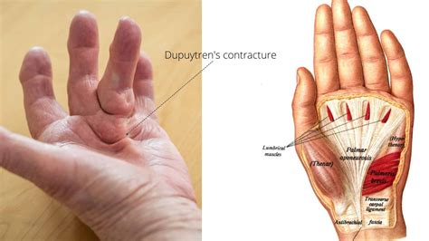 Easy Dupuytren S Contracture Exercises For Finger Pain Relief