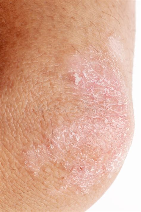Psoriasis On Elbow Stock Image Image Of Peeling Dermatology 40723091