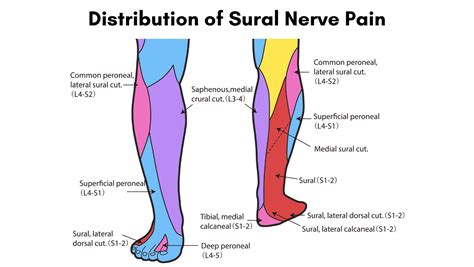 Sural Nerve Pain Ease Your Sural Nerve Pain