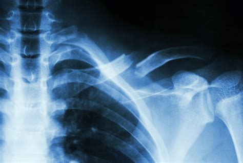 Broken Collarbone Symptoms And Recovery Orthoindy Blog