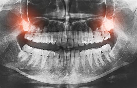 3 Warning Signs Of Impacted Wisdom Teeth