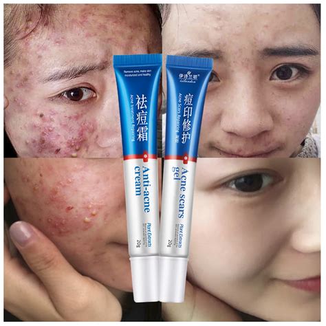 Isilandon Face Care Clear Vanishing Acne Treatment Creamacne Scars