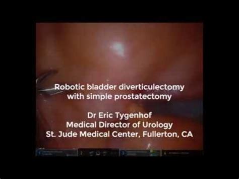 Robotic Bladder Diverticulectomy With Simple Prostatectomy Youtube