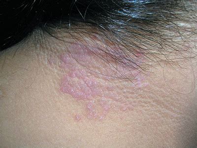 Skin Cancer Neck Rash