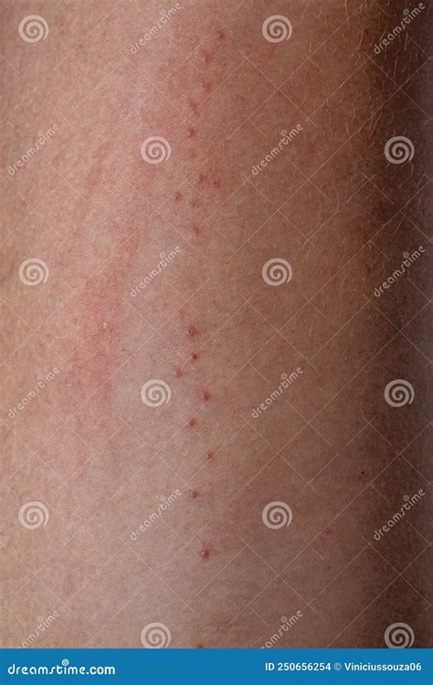 Allergic Reactions To Tick Bites Stock Photo Image Of Allergic