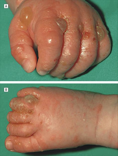 Childhood Bullous Pemphigoid Clinical And Immunological Findings In A