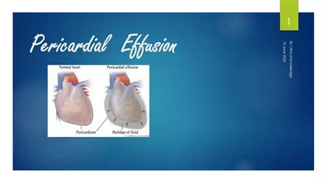 Pericardial Effusion Definition Causes Signs And Symptoms Investigation And Management