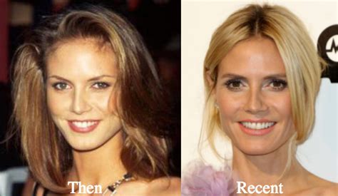 Heidi Klum Plastic Surgery Before And After Photos Latest Plastic