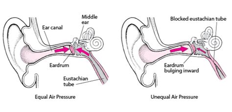 Eustachian Tube Dysfunction Clean Ears Christchurch Ear Wax Removal