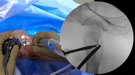 Arthroscopic Hip Labral Repair And Lesser Trochanter Excision For
