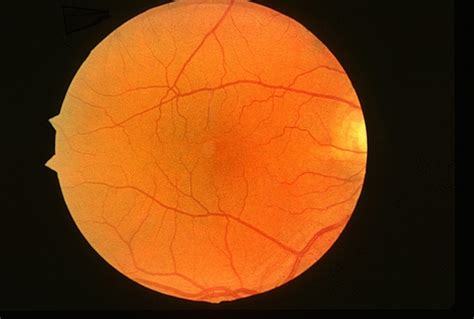 Normal Eye Retina Image Bank