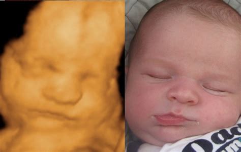 Before And After Photo Gallery 3d And 4d Ultrasound Virginia Baby