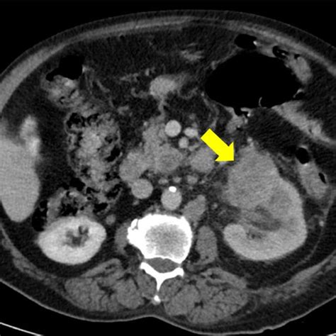 Axial Image Of Contrast Enhanced Ct Demonstrating An Exophytic