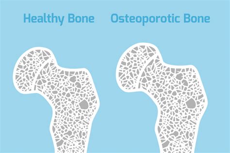 Osteoporosis Farnsworth Orthopedic Physical Therapy