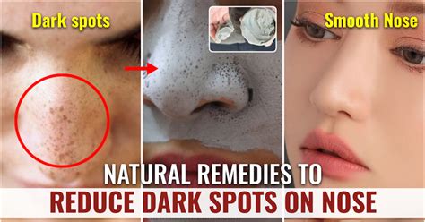 8 Effective Natural Remedies To Treat Dark Spots On Nose