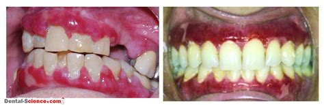 Desquamative Gingivitis Causes Signs Diagnosis And Management
