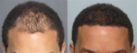 Men S Hair Transplant Before After Pictures Dr Sean Behnam Md