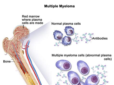 Mgus Markers Predict Risk Of Progression To Multiple Myeloma Nci