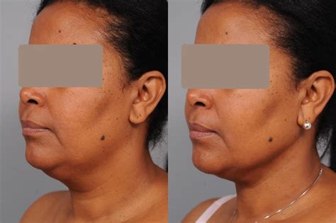 Smartlipo™ Neck Liposuction In New York Dr Sterry