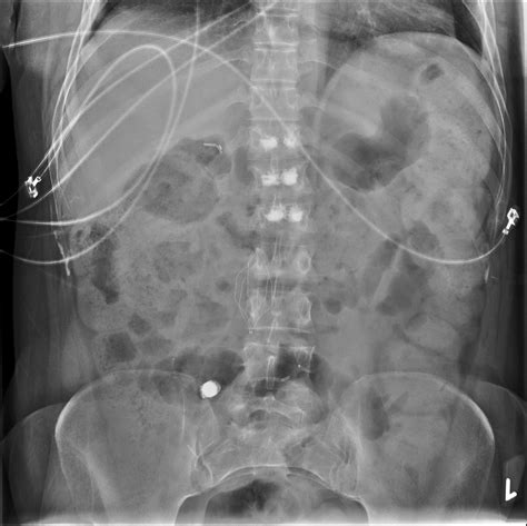 Nothing creative you will say! Capsule endoscopy and IVC filter on abdominal x-ray | Image | Radiopaedia.org