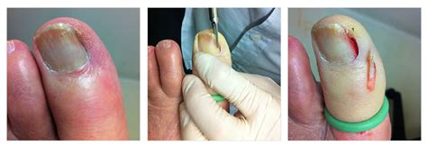 Ingrown Toenails Treament And Surgery Dr Gordon Slater Foot And Ankle
