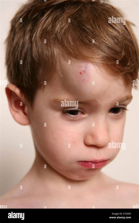 Child Hematoma Hi Res Stock Photography And Images Alamy