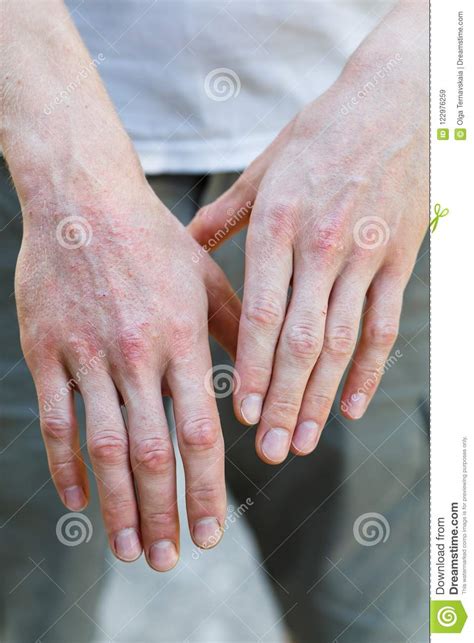 Psoriasis Vulgaris On The Mans Hands With Plaque Rash And