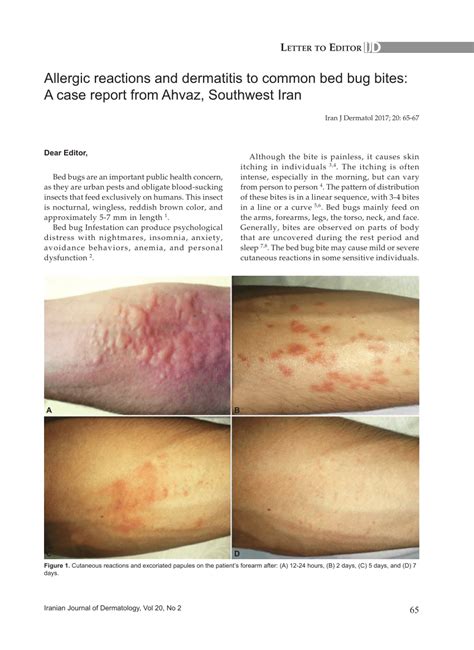 Pdf Allergic Reactions And Dermatitis To Common Bed Bug Bites A Case