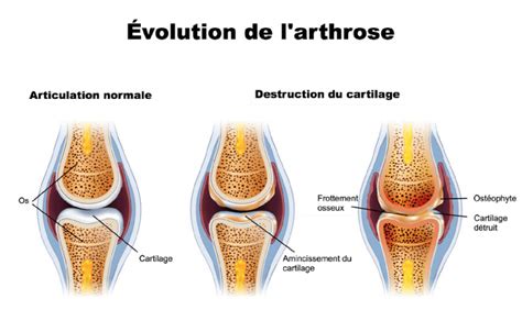 Larthrose Causes Symptômes Prévention Et Traitement De Larthrose