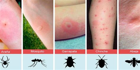 Alergia A Mosquito Sintomas