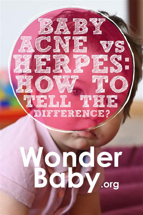 Baby Acne Vs Herpes How To Tell The Difference