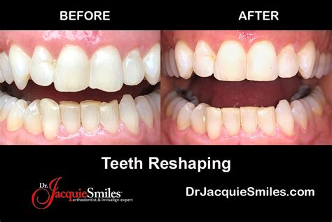 Tooth Reshaping And Dental Contouring In Nycdr Jacquie