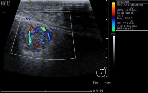 Giant Tumour Of The Breast Eurorad