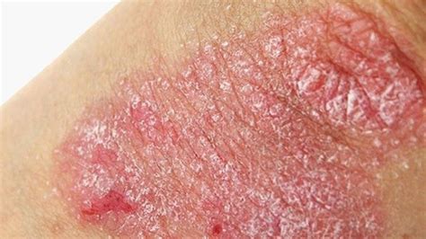 qué es y cuál es la causa de la psoriasis el debate