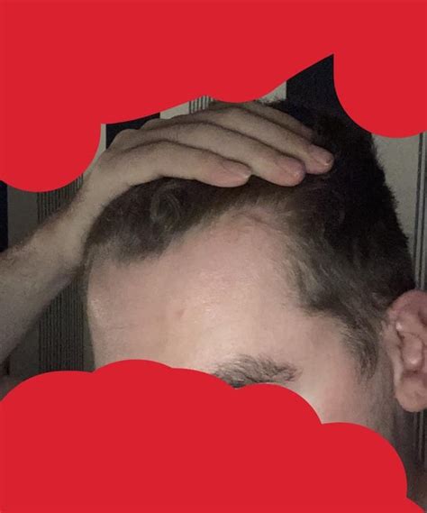 Is My Hairline Receding Or Is This Just A “maturing” Hairline R Malegrooming